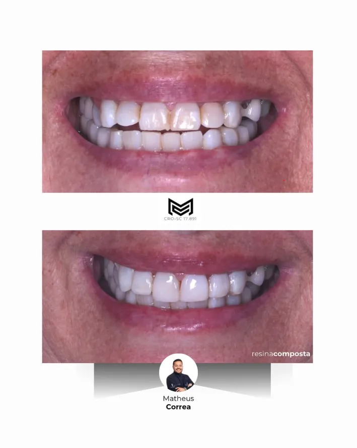 Antes e depois de dentística estética — Dr. Matheus Correa dentista em Florianópolis