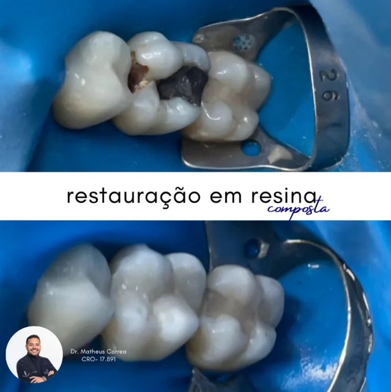 Antes e depois de clareamento dental em Florianópolis — Dr. Matheus Correa